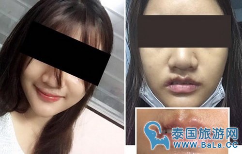 泰国女老板整容失败获赔76.5万铢赔偿