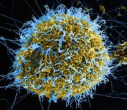 世界上最恐怖的十种病毒，埃博拉病毒居榜首