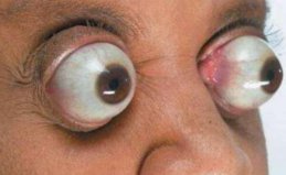 世界上眼球最突出的女人，金·古德曼的眼睛向外凸出11毫米